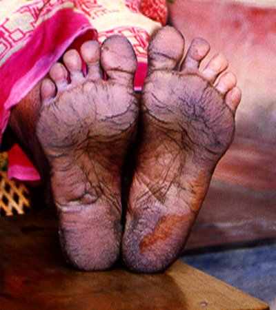 Keratosis of the feet.