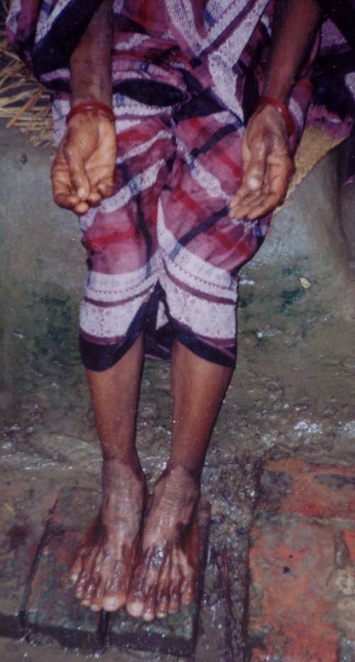 Photograph of a Bangladeshi female with keratosis of the palms and blackfoot disease.